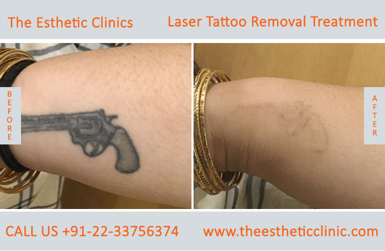 Permanent Laser Tattoo Removal Treatment before after photos in mumbai india (1)
